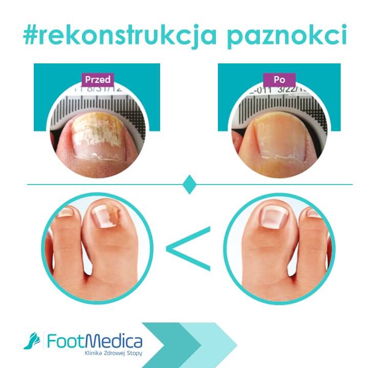 Rekonstrukcja paznokcia, kiedy paznokcie potrzebują wsparcia podologa