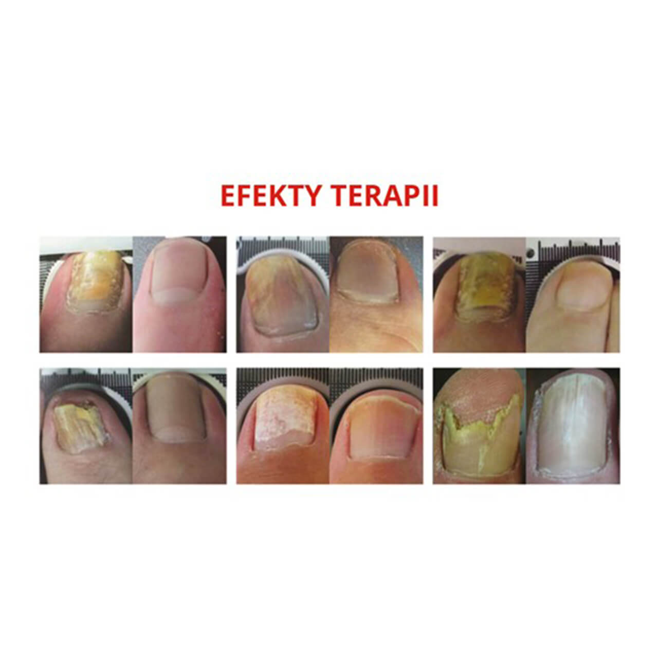 Efekty leczenia laserem lunula